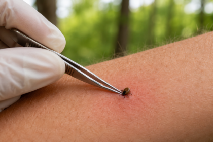 Close-up of a tick attached to human skin with fine-tipped tweezers positioned for safe removal